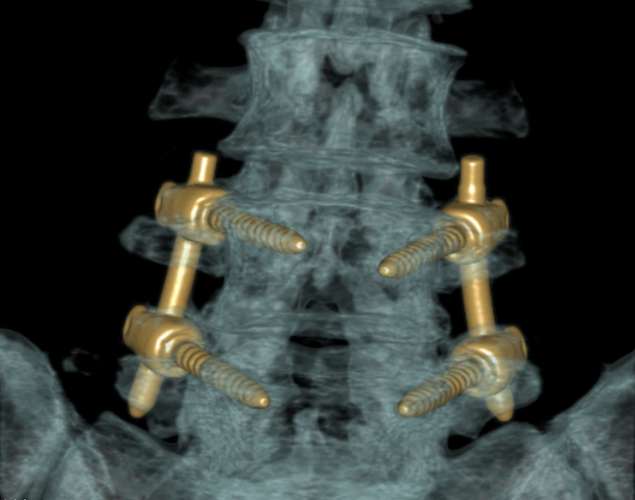 L4/5 lumbar instrumented fusion with pedicle screws